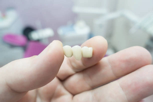 dental-bridges-ottawa-ontario