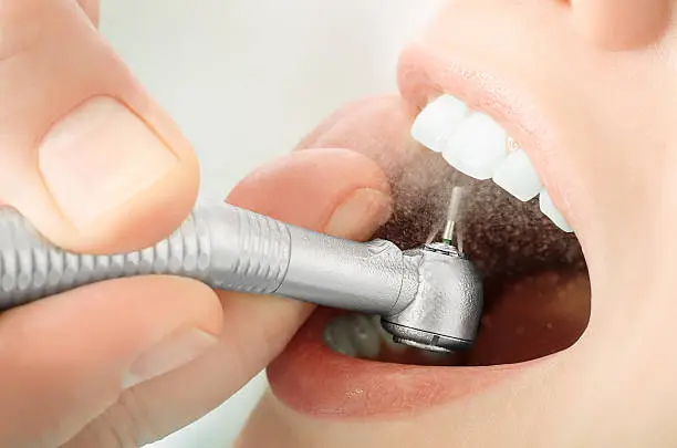 dental-cleanings-ottawa-on