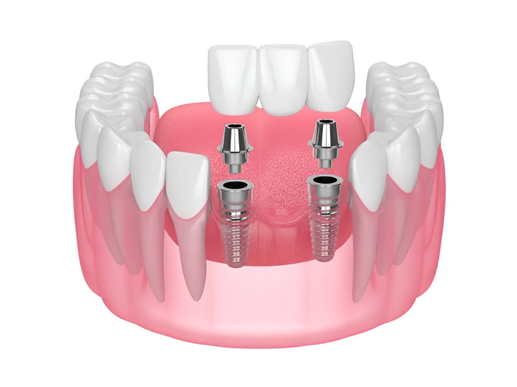 dental-crowns-and-bridges-ottawa