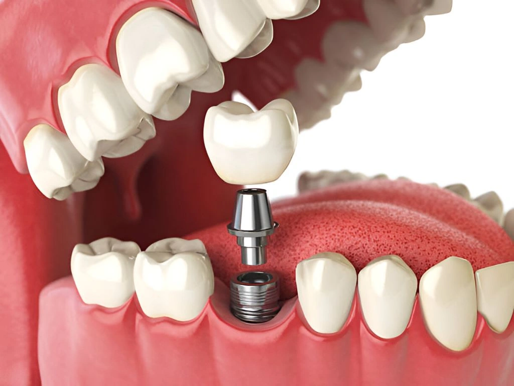 dental-implants-ottawa