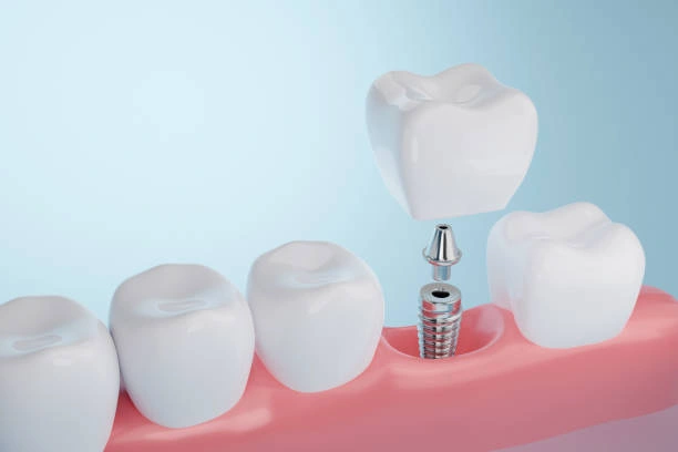 dentalimplants-ottawa-ontario