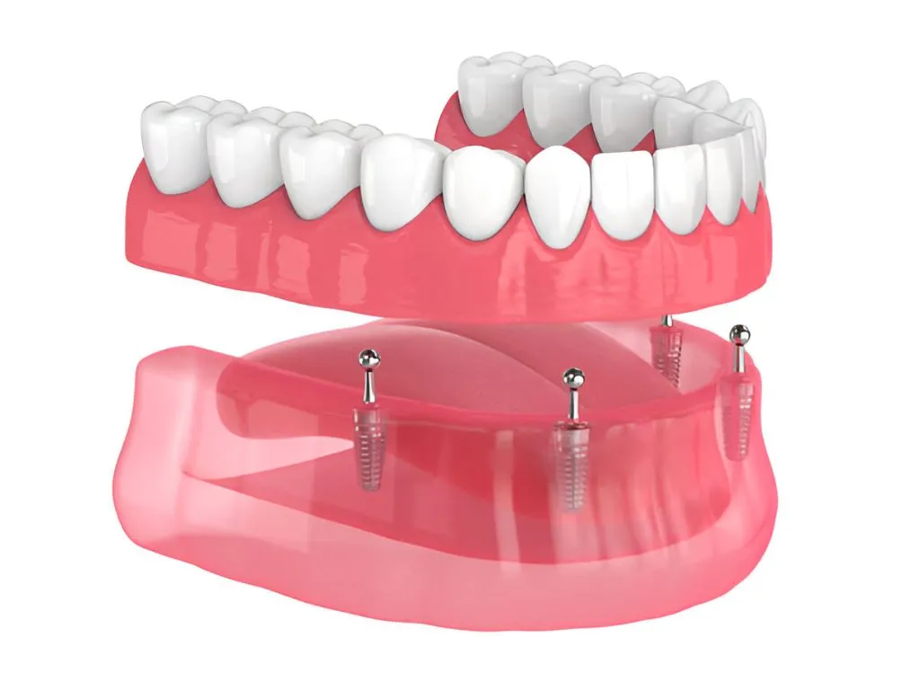 dentures-ottawa