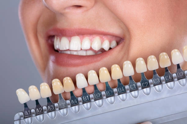teeth-whitening-near-me-ottawa-on